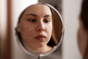 Acne scars Treatment