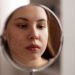 Acne scars Treatment